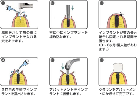 1.麻酔をかけて顎の骨にインプラントを入れる穴をあけます。　2.穴に中にインプラントを埋め込みます。　3.インプラントが顎の骨と結合し固定される期間を置きます。（3～6ヶ月：個人差があります。）　4.２回目の手術でインプラントを露出させます。　5.アバットメントをインプラントに装着します。　6.クラウンをアバットメントにかぶせて完了です。